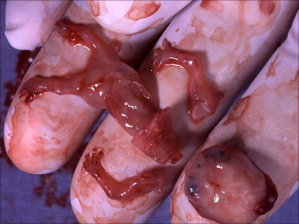 9-week-old aborted fetus.