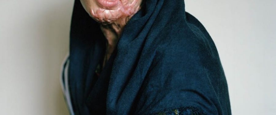 “My loving father threw acid in my face…”