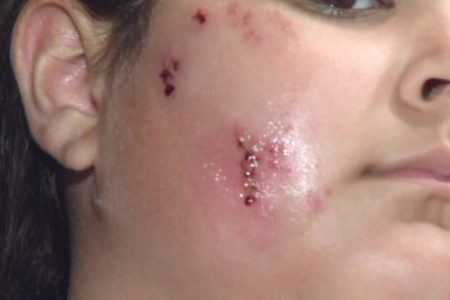 Girl Recovers After Pit Bull Attack