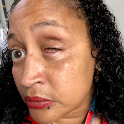 Calls On Bronx DA To Dismiss Charges Against Johanna Pagan-Alomar Who Lost Her Eye During Violent Arrest