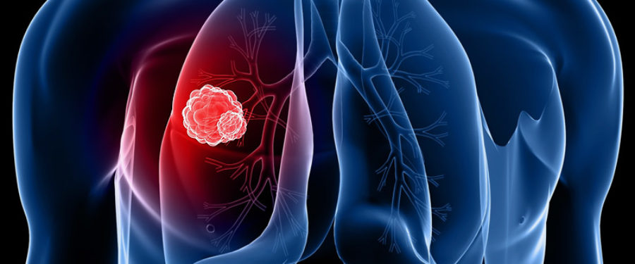 Lung Cancer