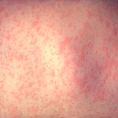 Measles Outbreak In Upper Manhattan & Bronx