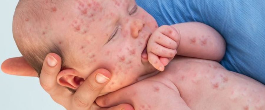 Orders To All Yeshivas In Williamsburg To Exclude Students Not Vaccinated For Measles