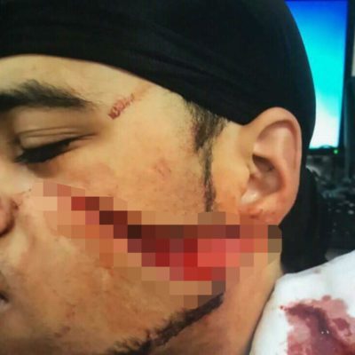 Bronx Inmate Brutally Slashed In The Face
