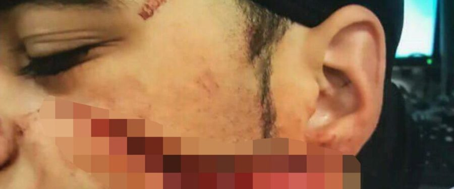 Bronx Inmate Brutally Slashed In The Face